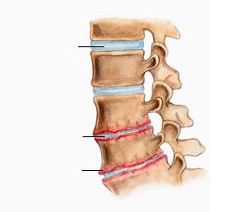 co je to osteochondróza